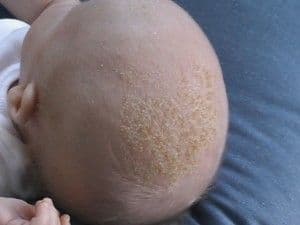 baby_with_cradle_cap.jpg