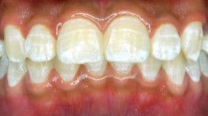 fluorosis_sstock_766250944_0.jpg