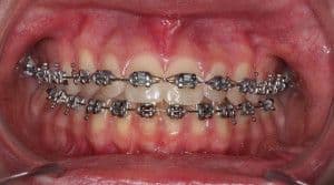 maloclusion.jpg