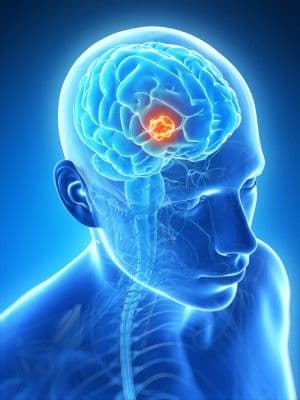 tumor_cerebral.shutterstock_128571581.jpg