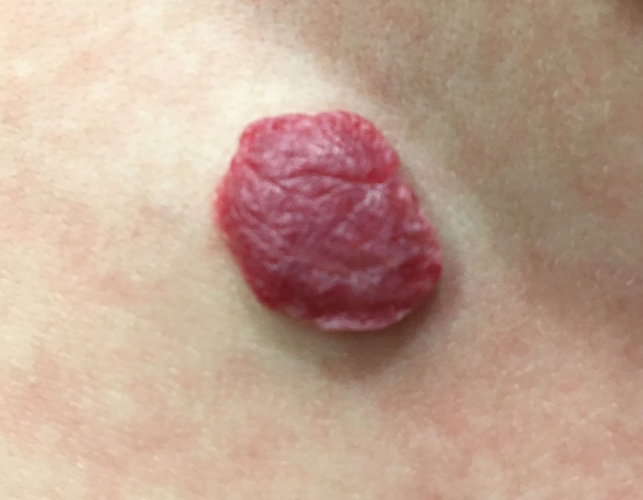 hemangioma.jpg
