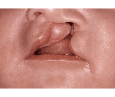 hendidura_labiopalatina_unilateral_total.png